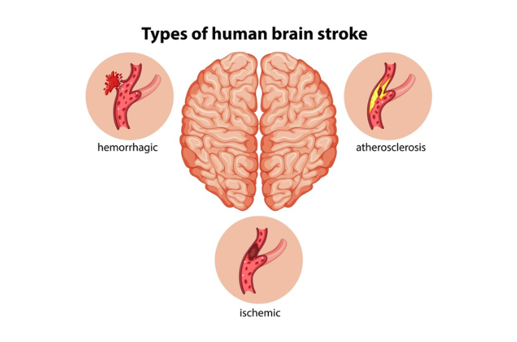 dr.pravalika Stroke